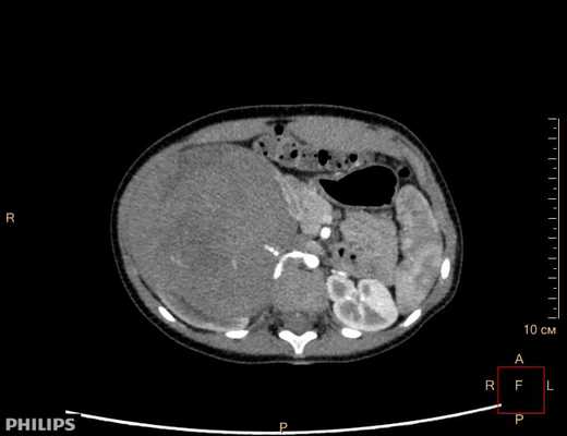 Опухоль Вильмса. Компьютерная томография