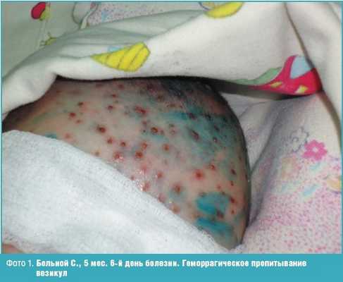 Фото 1. Больной С., 5 мес. 6-й день болезни. Геморрагическое пропитывание везикул