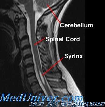 МРТ при сирингомиелии