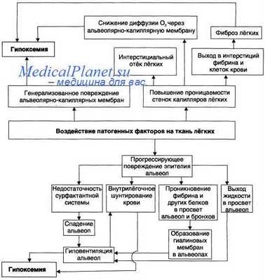 Респираторный дистресс-синдром