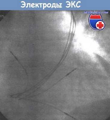 Электроды кардиостимулятора