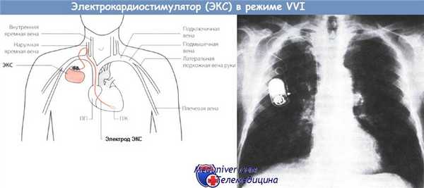 Электрокардиостимулятор в режиме VVI