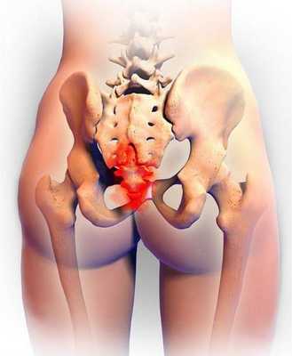Боль в области крестца и копчика