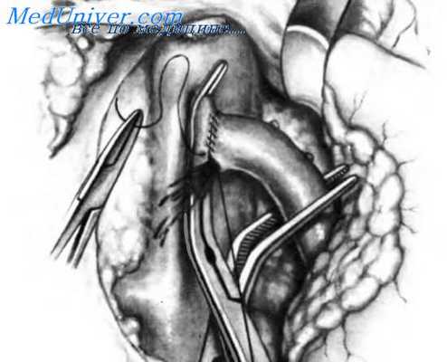 завершенный портокавальный анастомоз