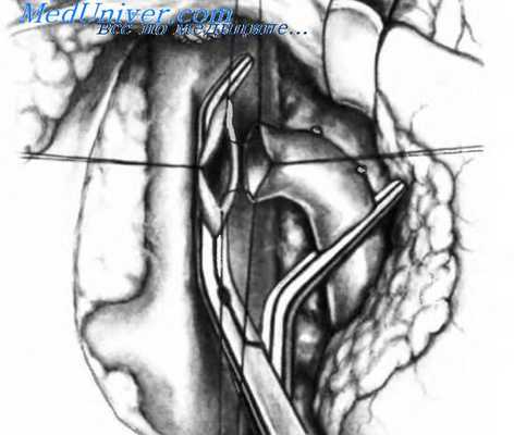 этапы наложения портокавального анастомоза