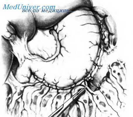 дистальный спленоренальный анастомоз