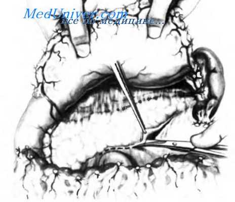 наложение спленоренального анастомоза