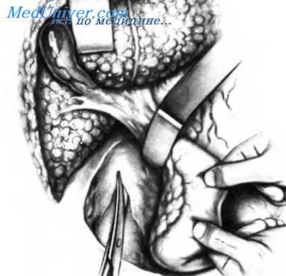 методика наложения портокавального анастомоза