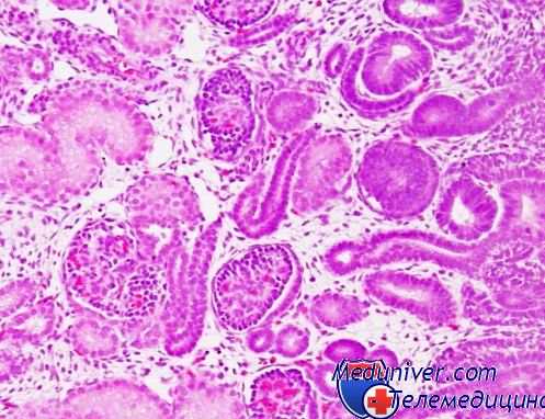 септикопиемия