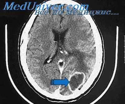 КТ при субдуральном абсцессе головного мозга