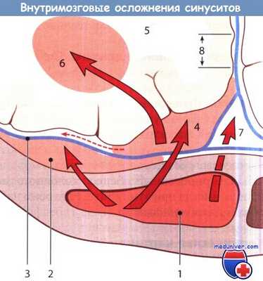 Внутримозговые осложнения синуситов