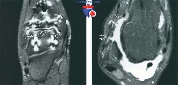 Послеоперационные изменения голеностопного сустава на артрограмме