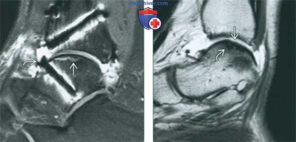 Послеоперационные изменения голеностопного сустава на артрограмме
