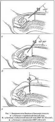 Лапароскопическая гистерэктомия у больных ожирением