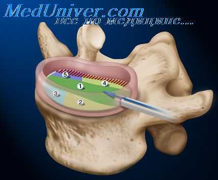 стабилизация позвоночника