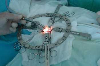 При некоторых заболеваниях и патологиях опорно-двигательного аппарата и особенно позвоночника решение об оперативном вмешательстве принимается как крайняя мера или в качестве срочного лечения.