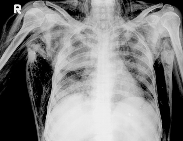 Подкожная эмфизема на рентгене