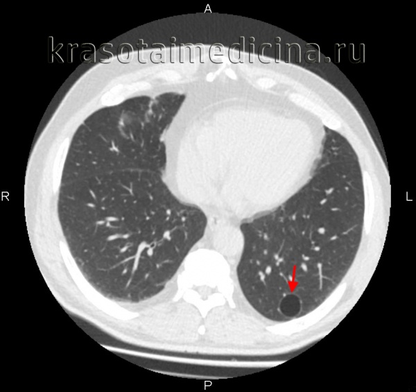 Буллезная эмфизема легкого