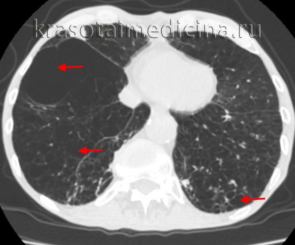 КТ ОГК. Множественные буллы обоих легких