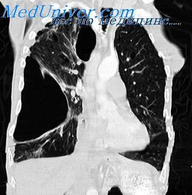 плевральные сращения