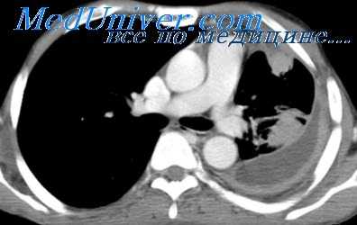 плевральные сращения