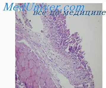 подкожная эмфизема