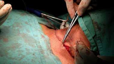 Отдаленные результаты и качество жизни пациентов после ранений шеи