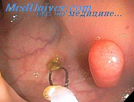 эндоскопическая полипэктомия