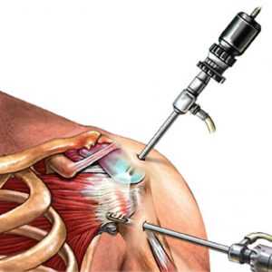 Артроскопия плечевого сустава