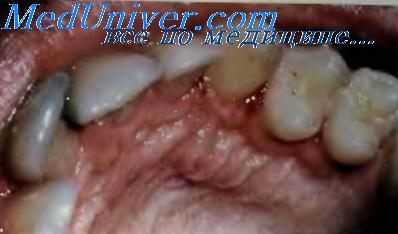 Болезнь Рандю—Вебера—Ослера