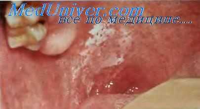 Лейкоплакия щеки