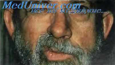 Паралич Белла