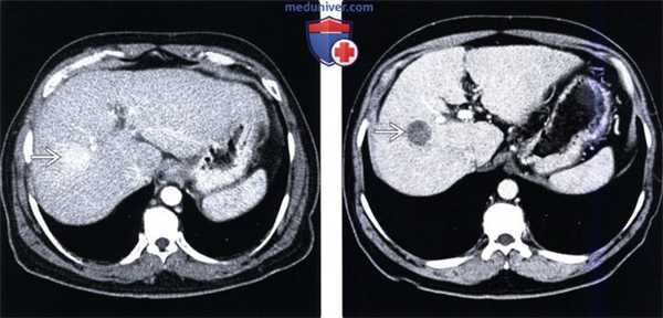 КТ изменения печени после операции