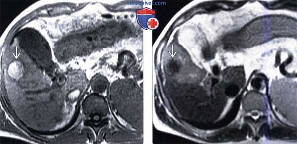 КТ изменения печени после операции
