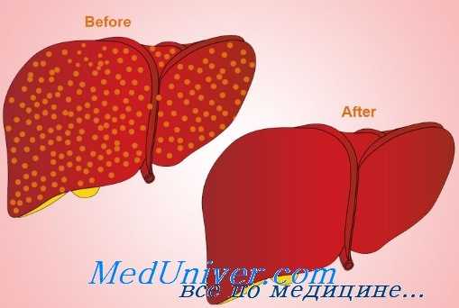 гепаторенальный синдром