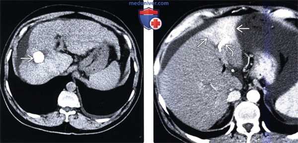 КТ изменения печени после операции