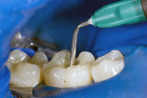 Лечение зубов