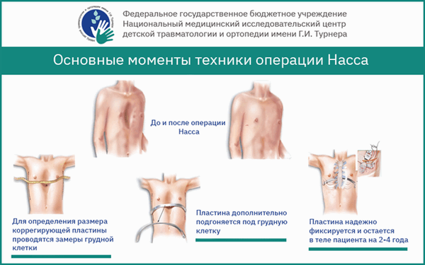 операция насса, операция по нассу