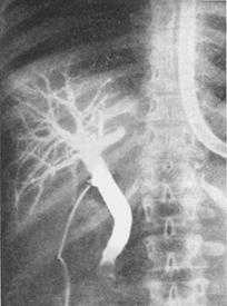 конкремент в дистальном отделе холедохе