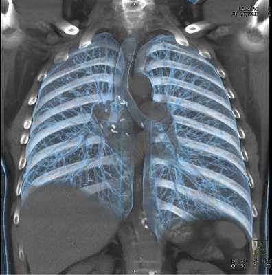 Мультиспиральная КТ грудной клетки, 3D-реконструкция