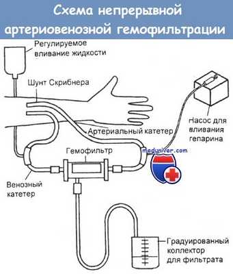 Схема непрерывной артериовенозной гемофильтрации (НАВГ)