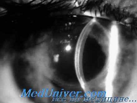 лечение афакии