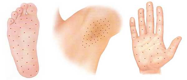 Лечение гипергидроза диспортом