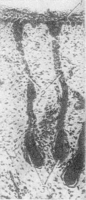 Рис. 3. Микропрепарат кожи подошвы плода 18 недель (зачатки эккринных потовых желез): 1 — эпидермис, 2 — потовые протоки, 3 — концевые части потовых желез; окраска гематоксилин-эозином; х 100.