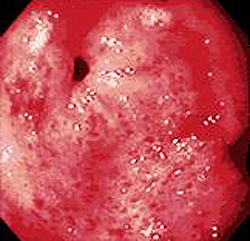 Эндоскопическая картина хронического гастрита