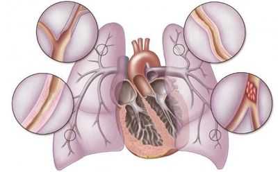 Места изменения давления в легочных капиллярах и венах