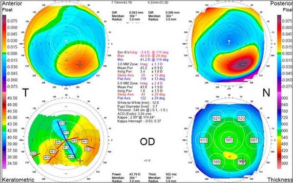толщина роговицы на кератометрии