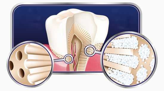 Закупорка дентинных канальцев веществами, содержащимися в зубной пасте