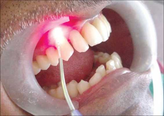 Лазеротерапия гиперестезии