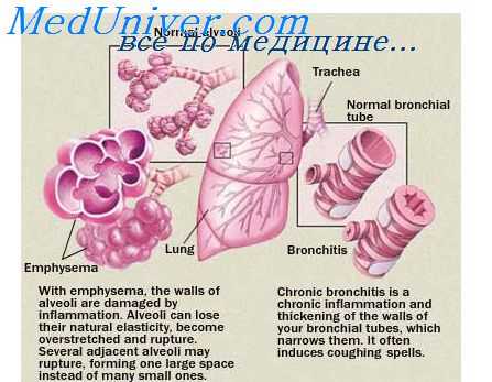 перестройка легких при пневмонии